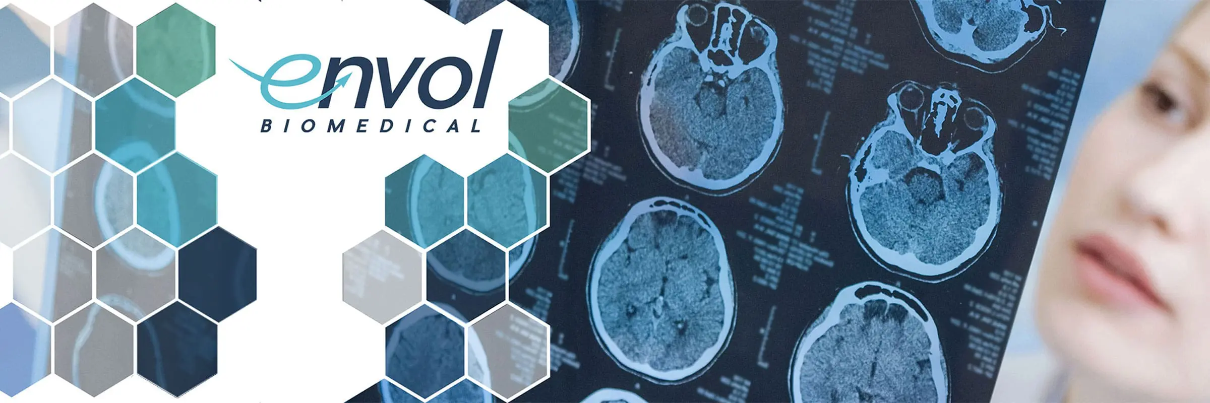 Featured image for “Register Now to Attend Envol Biomedical and ClearPoint Neuro Webinar on Advanced Drug Delivery to the CNS in Nonhuman Primates”